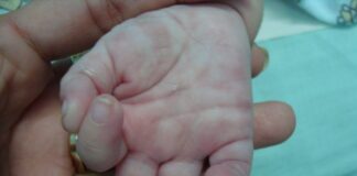 ¡Alerta! Recién nacidos nacen contagiados de sífilis en Hospital del Sur