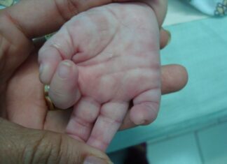 ¡Alerta! Recién nacidos nacen contagiados de sífilis en Hospital del Sur