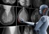 La Inteligencia Artificial permitirá avanzar hacia un tratamiento menos invasivo del cáncer de mama