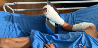 Aumenta en un 100 % los casos de niños quemados por pólvora en Honduras