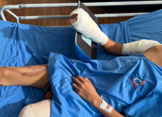 Aumenta en un 100 % los casos de niños quemados por pólvora en Honduras