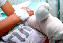 Otro menor es ingresado con graves quemaduras por manipular pólvora