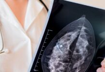 Estudio no ve grandes cambios en combinación de fármacos para cáncer de mama avanzado