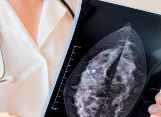 Estudio no ve grandes cambios en combinación de fármacos para cáncer de mama avanzado