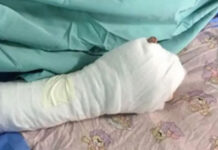 Explosión de mortero le cercena dedos a niño de 10 años en el departamento de Yoro