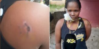 Hospitalizan a mujer que fue atacada a mordidas por su pareja en Olancho