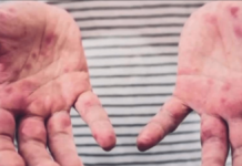 Reportan un caso de sarampión en el refugio para migrantes más grande de Chicago (EE. UU.)