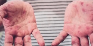 Reportan un caso de sarampión en el refugio para migrantes más grande de Chicago (EE. UU.)