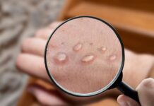 Suecia confirma el primer caso de la variante más peligrosa de viruela del mono fuera de África