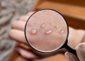 Suecia confirma el primer caso de la variante más peligrosa de viruela del mono fuera de África