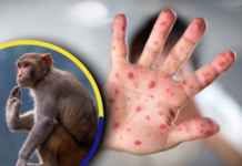 Se ha reportado el primer caso sospechoso de Viruela del Mono en Honduras