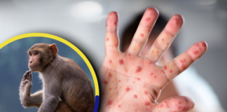 Se ha reportado el primer caso sospechoso de Viruela del Mono en Honduras