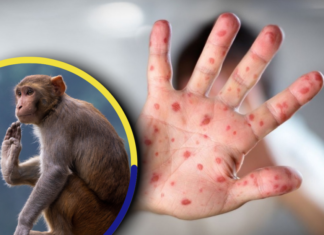 Se ha reportado el primer caso sospechoso de Viruela del Mono en Honduras