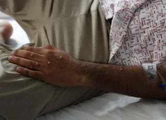 La OMS decreta emergencia sanitaria internacional por viruela del mono ante aumento de casos en África