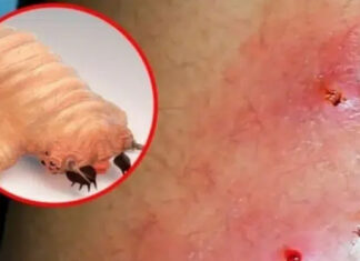 Nicaragua reporta 30 casos del gusano barrenador en humanos