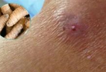 Honduras registra cuatro muertos y 125 casos de gusano barrenador en humanos