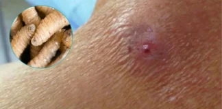 Honduras registra cuatro muertos y 125 casos de gusano barrenador en humanos