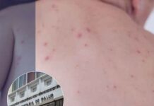 Sesal confirma nuevo caso de sarampión en un bebé de seis meses; ya suman 12 contagios en el país