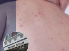 Sesal confirma nuevo caso de sarampión en un bebé de seis meses; ya suman 12 contagios en el país