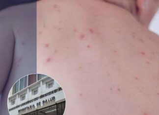 Sesal confirma nuevo caso de sarampión en un bebé de seis meses; ya suman 12 contagios en el país