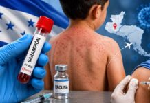 Aumentan a 10 los casos de sarampión en Honduras tras confirmarse cuatro nuevos contagios