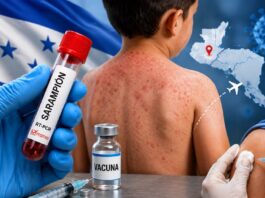 Aumentan a 10 los casos de sarampión en Honduras tras confirmarse cuatro nuevos contagios