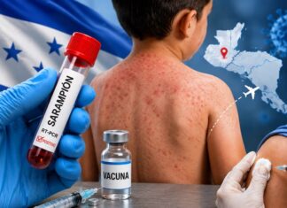 Aumentan a 10 los casos de sarampión en Honduras tras confirmarse cuatro nuevos contagios