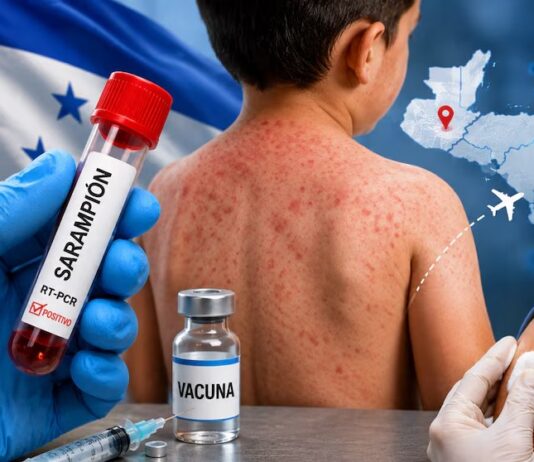 Aumentan a 10 los casos de sarampión en Honduras tras confirmarse cuatro nuevos contagios