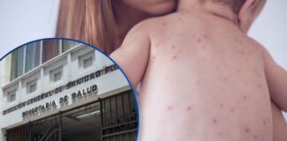 Sesal confirma nuevo caso de sarampión en un bebé de seis meses y refuerza llamado a la vacunación